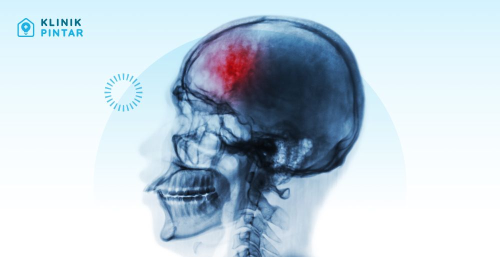 ilustrasi efek stroke pada otak